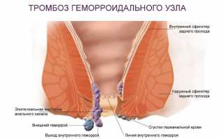 Ранние и отдаленные осложнения геморроя