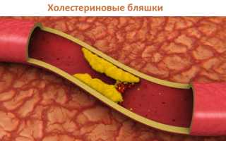 Подозрение на предынфарктное состояние: первая помощь и лечение