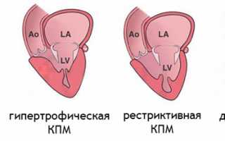 Насколько опасна дилатационная кардимиопатия, лечение и прогноз