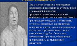 Что такое микседема?