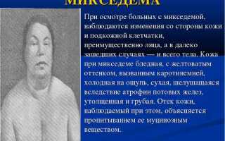 Что такое микседема?