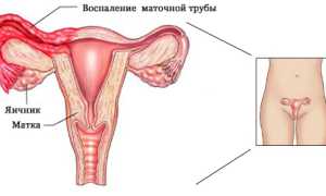 Симптомы воспаления яичников