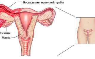 Симптомы воспаления яичников