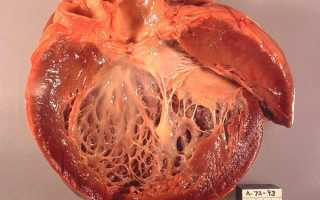 Как развивается и насколько опасен ревматический миокардит