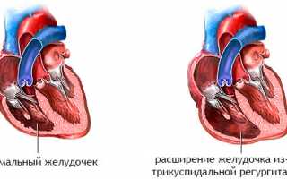 Как проявляется и лечится трикуспидальная регургитация