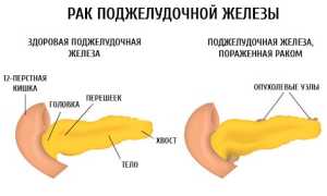 Продолжительность жизни при раке поджелудочной железы