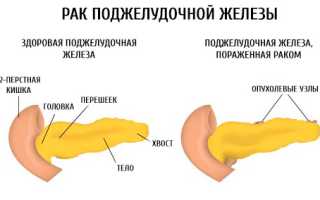 Продолжительность жизни при раке поджелудочной железы