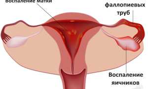 Можно ли забеременеть с воспалением яичников?