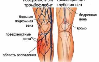 Лучшие ванны от варикоза: варианты и особенности