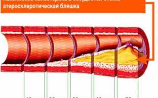 Самая дешевая, но эффективная чистка сосудов дома