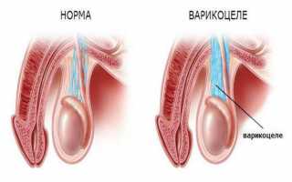 Редкий и неприятный варикоз полового члена: причины появления, терапия для мужчин