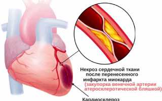 Правильное народное лечение кардиосклероза