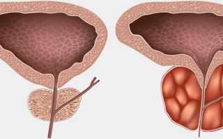 Можно ли вылечить хронический простатит?