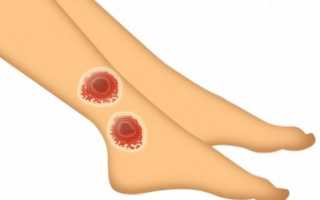 Трофические язвы на ногах и их лечение