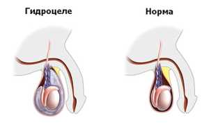Водянка оболочек яичка у мужчин (Гидроцеле)