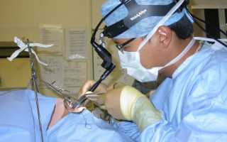 Как удаляют гланды у детей?