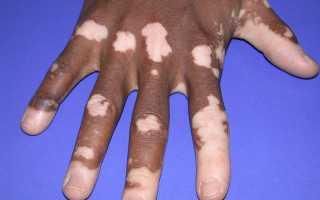 Хроническая надпочечниковая недостаточность