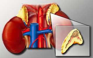 Опухоль надпочечников или феохромоцитома: симптомы и лечение