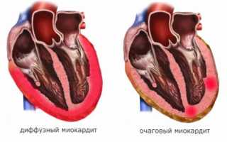 Насколько информативно ЭКГ при миокардите