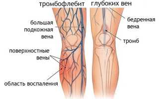 Полезные продукты при атеросклерозе