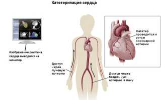 Исследовать полость миокарда и клапаны поможет катетеризация сердца: особенности подготовки, проведения и возможные осложнения