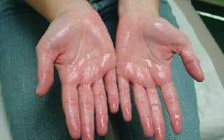 Что такое гипергидроз? Методы лечения избыточной потливости на различных участках тела