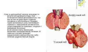Лечение узлового зоба