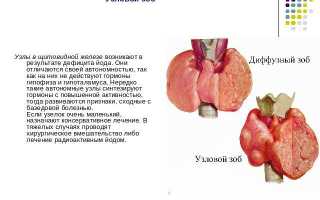 Лечение узлового зоба