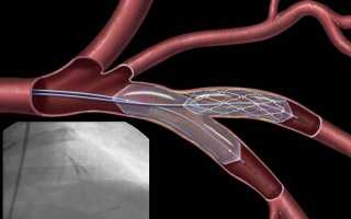 Операция стенирования сосудов сердца и ее последствия