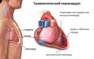 От чего возникает и как лечится травматический перикардит