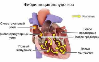 Проблемы с сердечным клапаном или аномалия Эбштейна