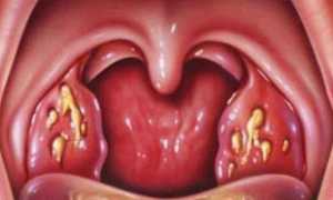 Белый налет на гландах без температуры