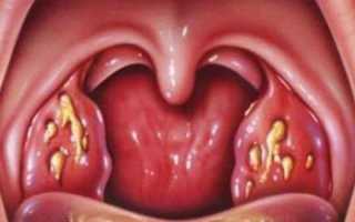 Белый налет на гландах без температуры