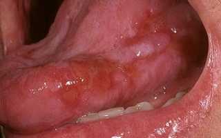 Как избавиться от красного плоского лишая в полости рта: эффективные методы лечения и общие рекомендации