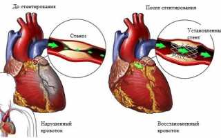 Спасительное стентирование после инфаркта: особенности установки, ограничения после