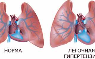 Чем опасна легочная гипертензия, методы выявления и борьбы с ней