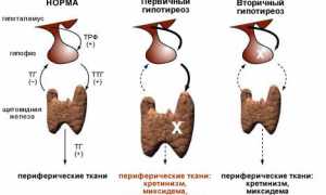 Гипотиреоз у женщин
