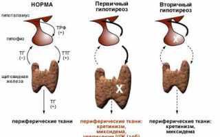 Гипотиреоз у женщин