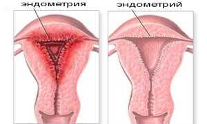 Выскабливание при гиперплазии эндометрия