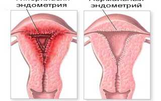 Выскабливание при гиперплазии эндометрия