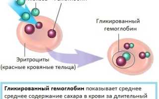 Угрожающая жизни аритмия при диабете