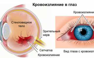 Почему лопнул сосуд в глазу