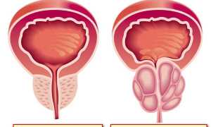 Лечение простатита и аденомы простаты