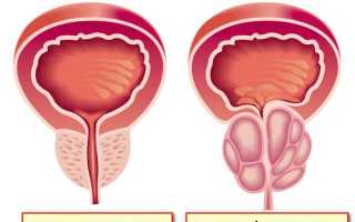 Лечение простатита и аденомы простаты