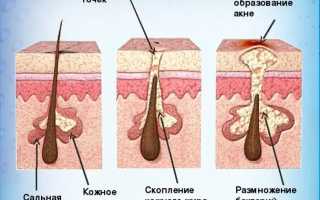 Акне: что такое кожный жир?