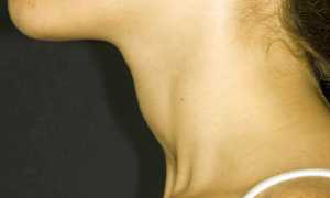 Как понять что щитовидка увеличена?