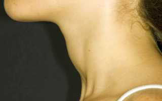 Как понять что щитовидка увеличена?