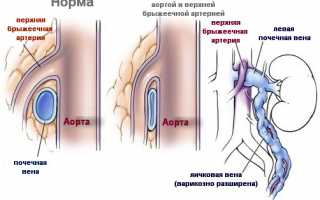 Варикоцеле: причины, симптомы и лечение