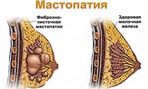 ФКМ полочной железы