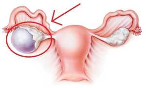Выделения при кисте яичника